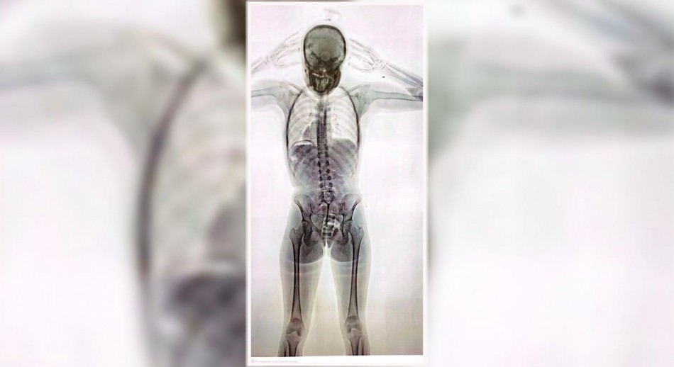 Detuvieron a una joven de 20 años con 78 cápsulas de cocaína en el cuerpo